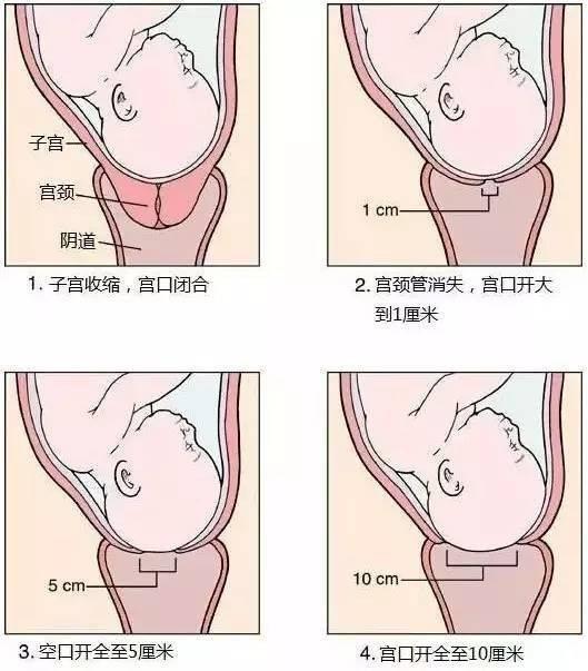 顺产宫口开十指，究竟是什么感觉？-第3张图片-爱薇女性网