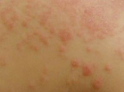 人身上被螨虫咬的图片，人被螨虫咬的5大症状-第3张图片-爱薇女性网