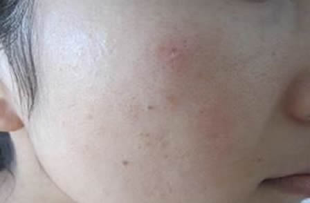 人身上被螨虫咬的图片，人被螨虫咬的5大症状-第4张图片-爱薇女性网