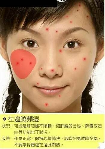 脸部各个部位长痘痘的原因示意图以及改善办法-第7张图片-爱薇女性网